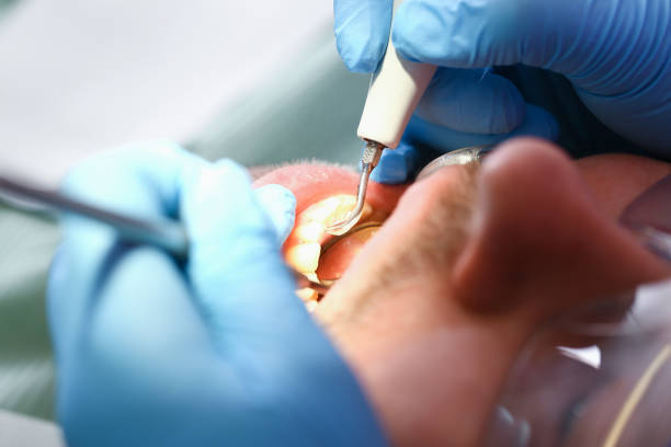 Best Emergency Tooth Extraction in Rankin, TX